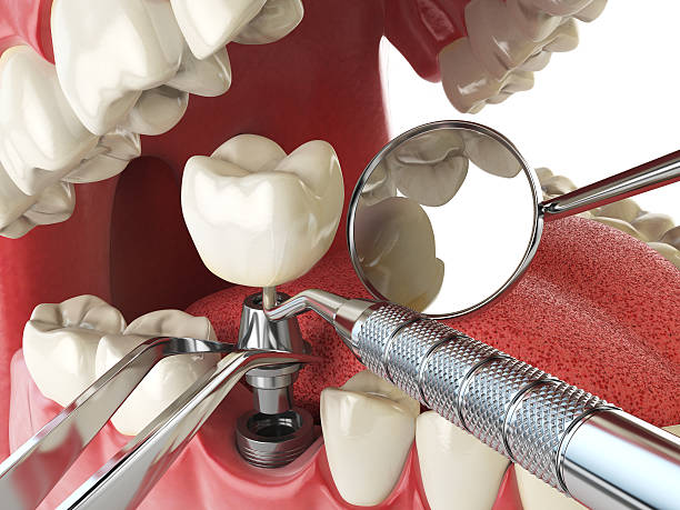 Best Emergency Broken Tooth Repair in Georgetown, CT